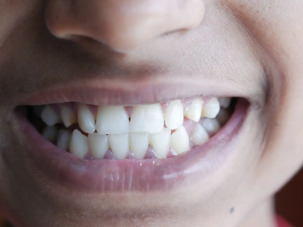 E-max Veneers