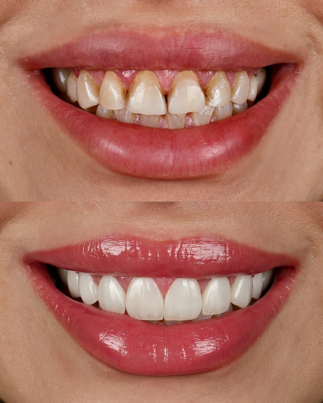 Hollywood Smile
